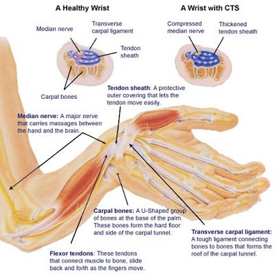 Carpal Tunnel Syndrome (CTS) 