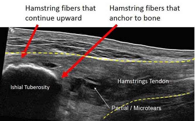 รูปแสดง ภาพกล้ามเนื้อ Hamstrings ที่มีการบาดเจ็บ โดยเครื่องอลตราซาวน์ 