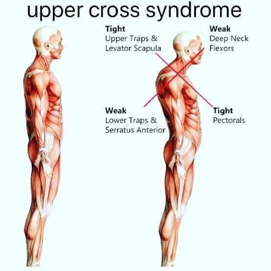 upper cross syndrome